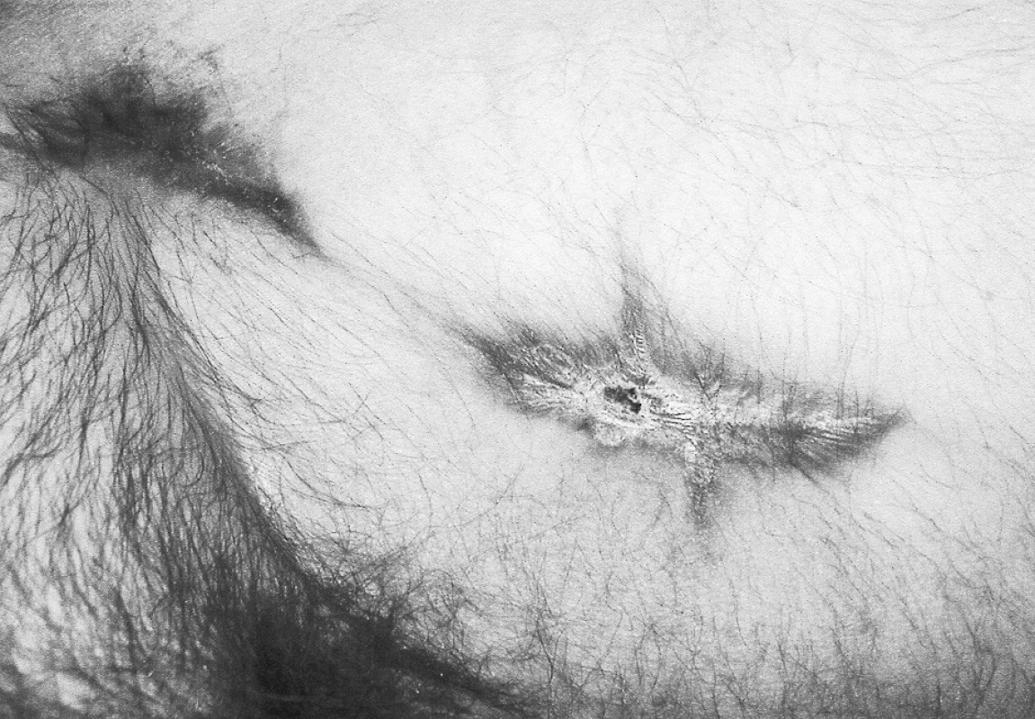 Rana po excízii pseuroaneuryzmy, stav po 4 mesiacoch
Pic. 4. The post- pseudoaneurysm excision wound, 4 months later