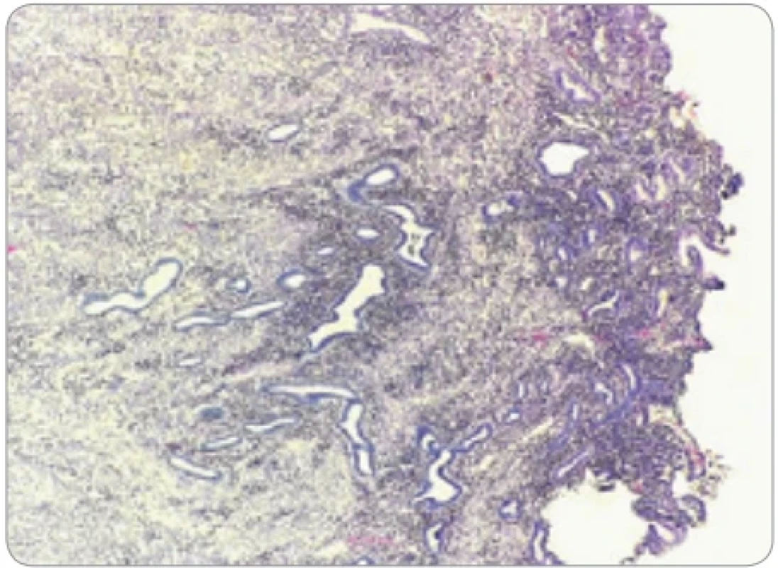 Atrofizované endometrium (vpravo) s ložiskami adenomyózy v priľahlom myometriu (vľavo). (Farbenie hematoxylín & eozín, zväčšenie 40×).