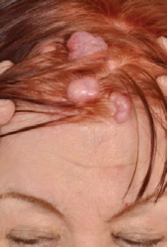 Cylindromas of the scalp.