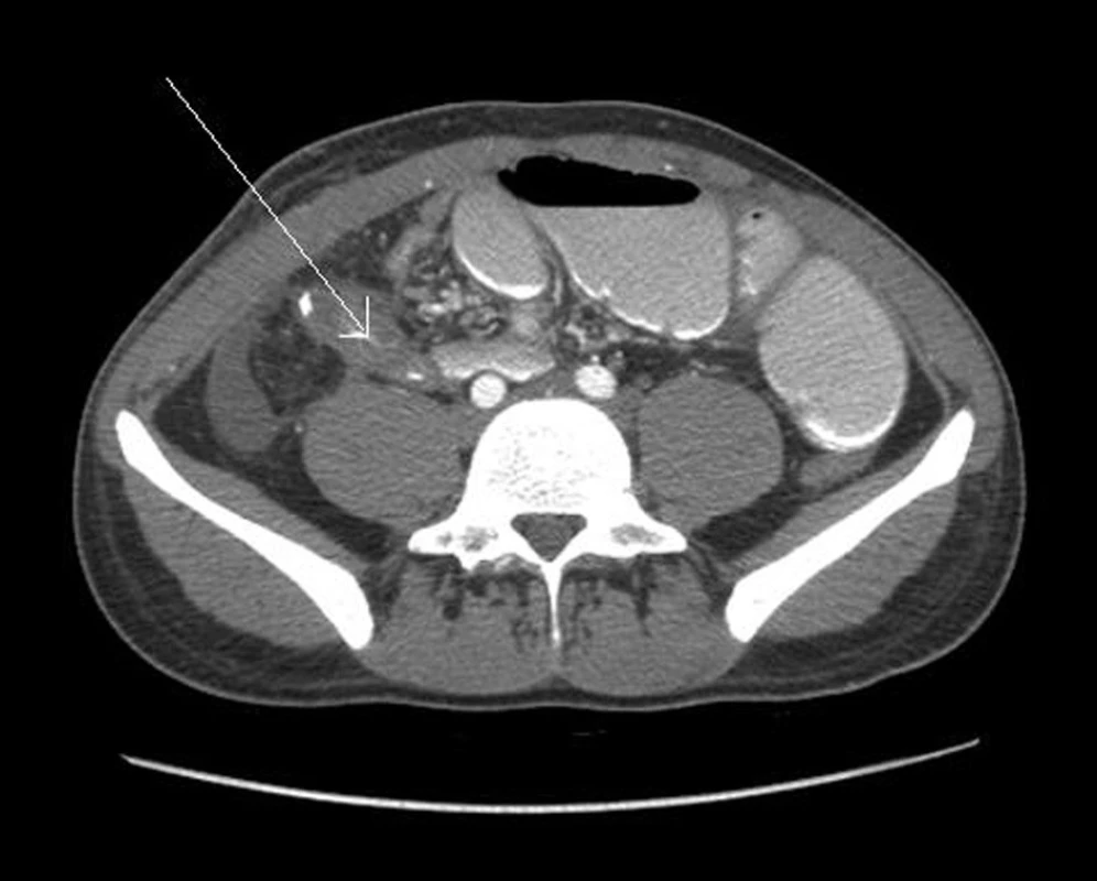 Kontrolní CT sken 9. pooperační den prokazující nádorové masy v oblasti ileotransverzoanastomózy
Fig. 2: Control CT scan on the ninth postoperative day showed tumor masses in the area of the ileo-colic anastomosis