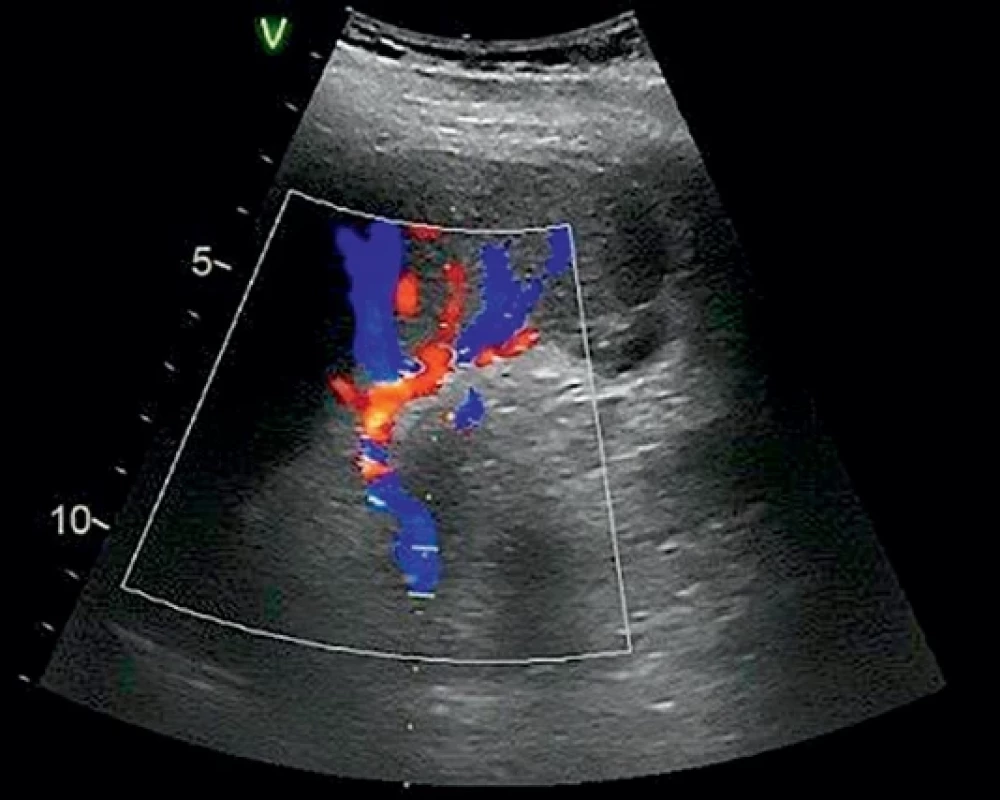 Kontrolní ultrazvukové vyšetření druhého pacienta.  Control ultrasound examination of the second patient.