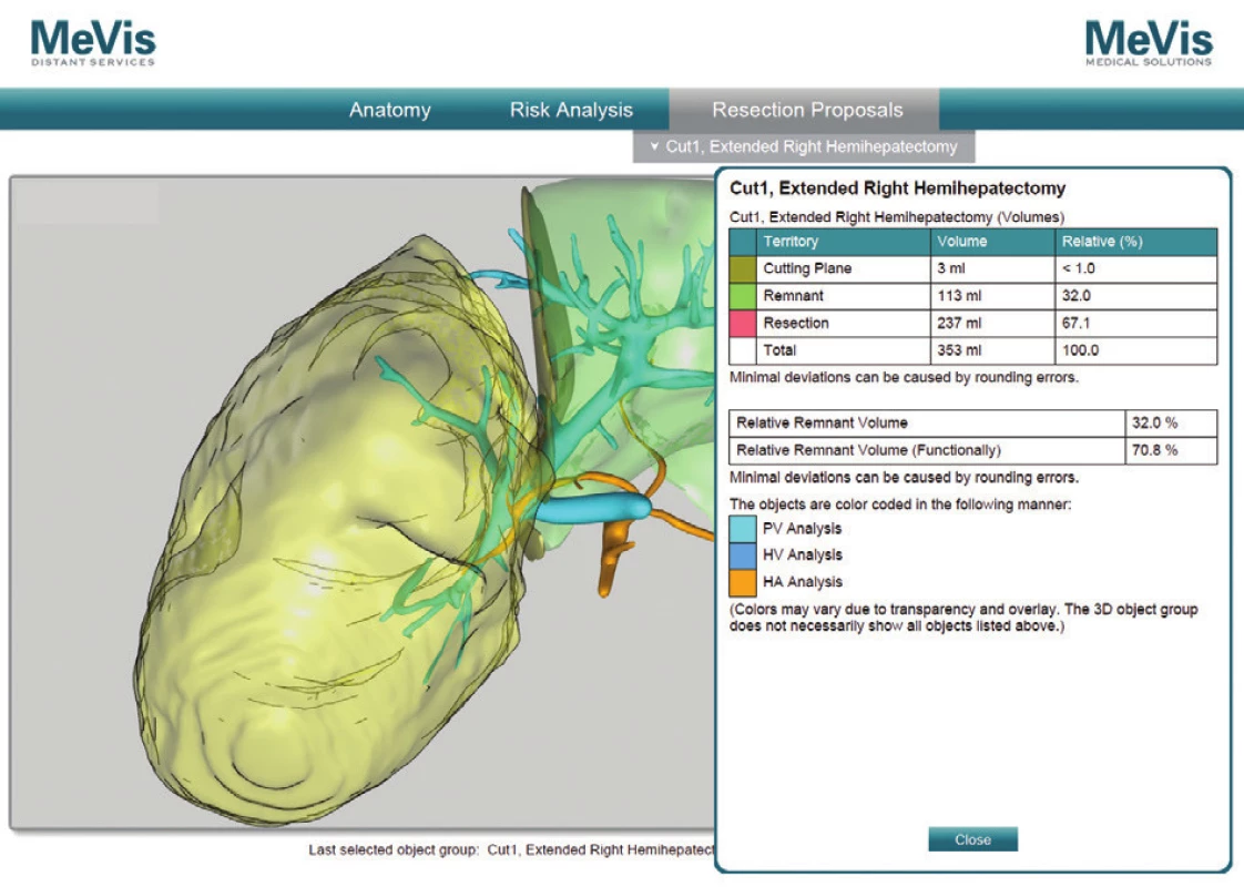 MeVis resekčný návrh a volumetria remnantu, pacient č. 5
Fig. 8: Mevis resection proposal and remnant volumetric analysis, patient No. 5