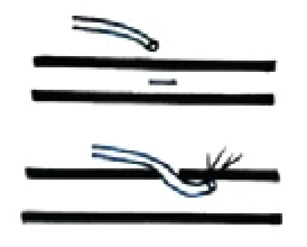 LV anastomosis end-to-side.
