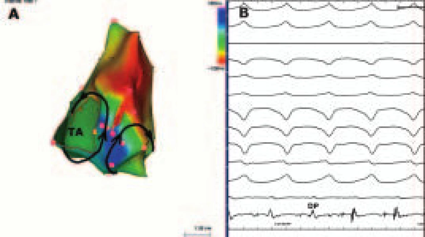 Elektroanatomické mapování reentry SMKT z laterobazální stěny pravé komory. 