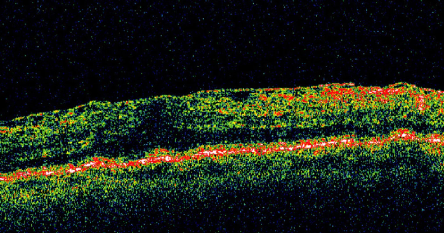 B-zobrazenie OCT: epiretinálna membrána a edém po operácii OS, sietnica priložená (69r., ♂, 6 mesiacov po episklerálnej serkláži a tamponáde C3F8)
