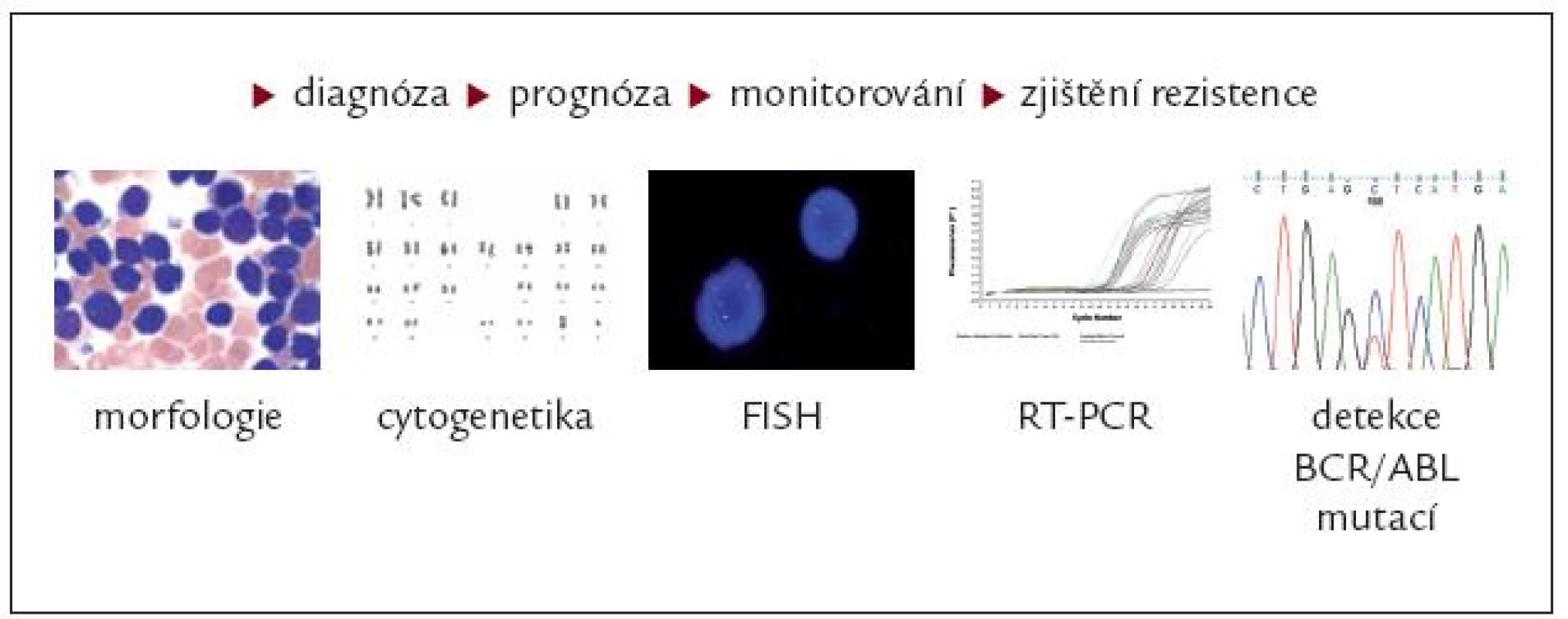 Sledování nemocných s CML léčených inhibitory tyrozinových kináz.