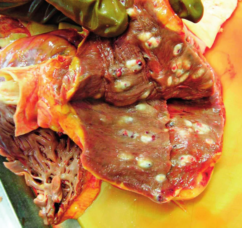 Početné metastázy malígneho melanómu v myokarde