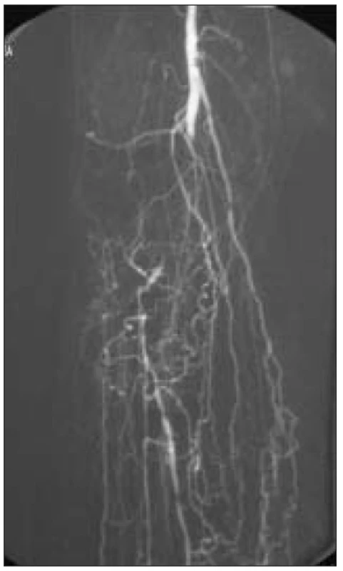 Angiografie – fragmentace bércového řečiště, žádná bércová tepna.