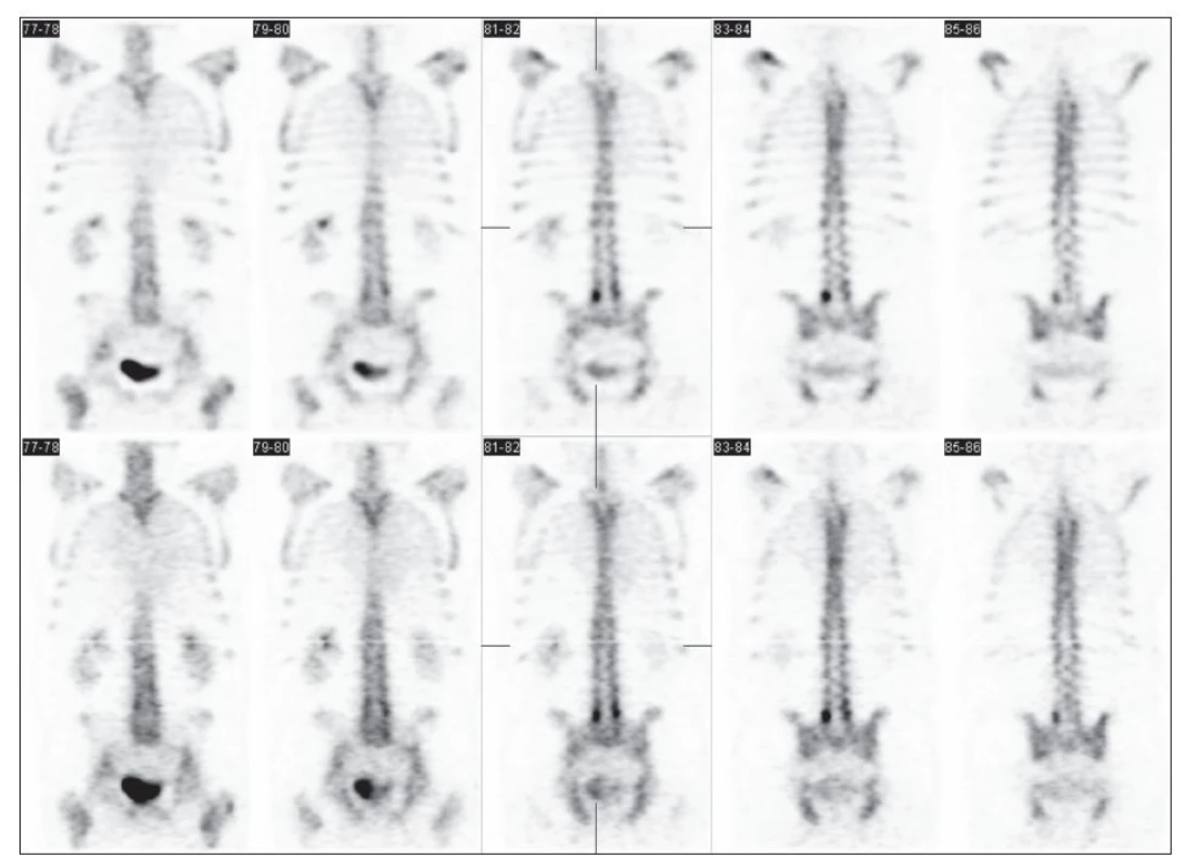 Příklad změn ve kvalitě SPECT obrazu skeletu po provedení úprav navrženým algoritmem (horní řádek) v porovnání s klinicky používanou OSEM.