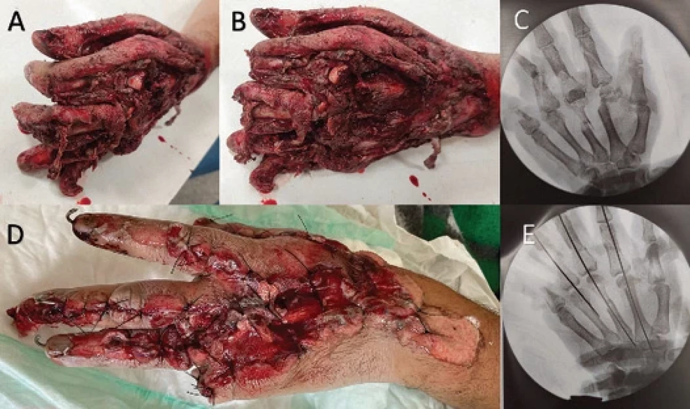 A) Initial appearance of the patient's left hand upon arrival at the hospital, anterior view; B) superior view; C) fl uoroscopy in the operating room of the left hand before reduction and fi xation of the bones; D) fi nal appearance of the left hand after debridement, cleaning, bone fi xation, and soft tissue suturing by the orthopedics team; E) fl uoroscopy in the operating room of the left hand after reduction and fi xation of the bones.