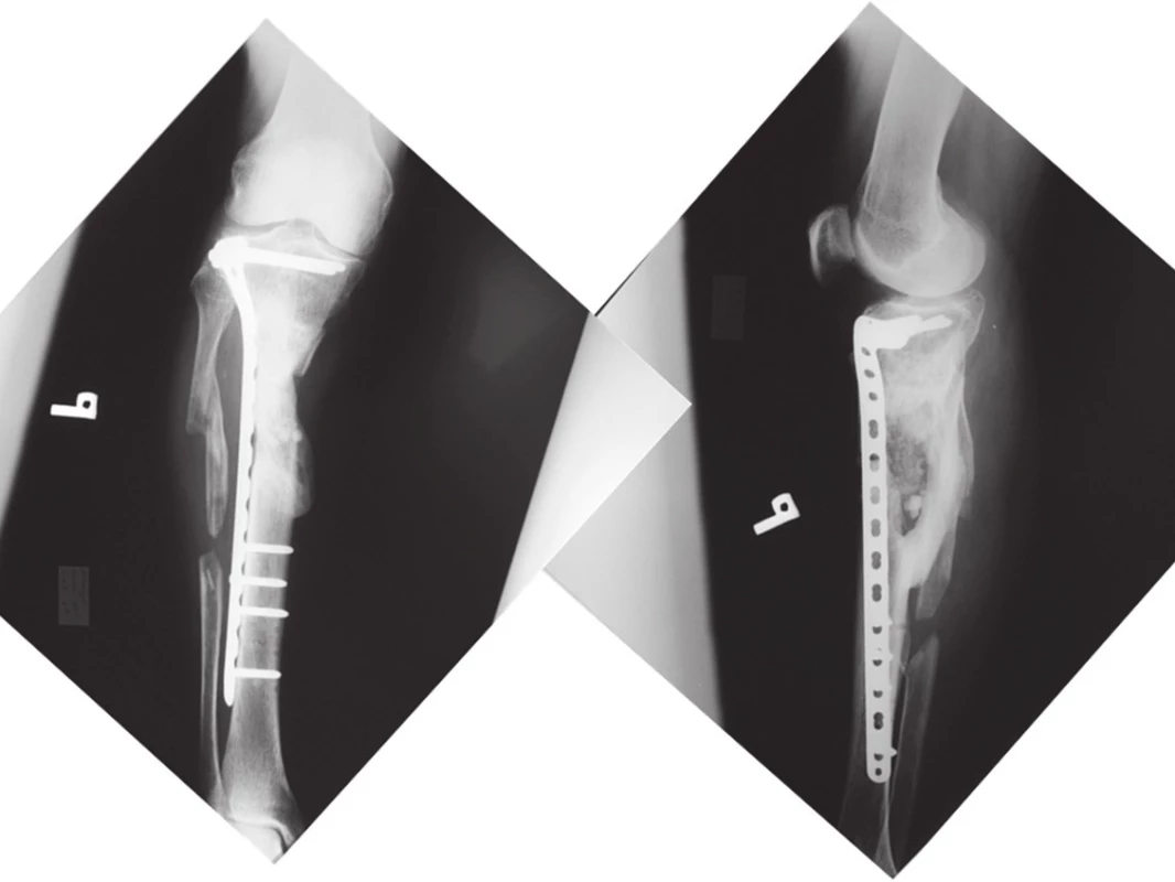 Kontrolný rtg obrázok pravého predkolenia - známky hojenia po 8. mesiacoch od úrazu, zlomenina premostená kalusom
Fig. 9: Follow-up x-ray – fracture of the right tibia healed 8 months after injury, obvious signs of healing