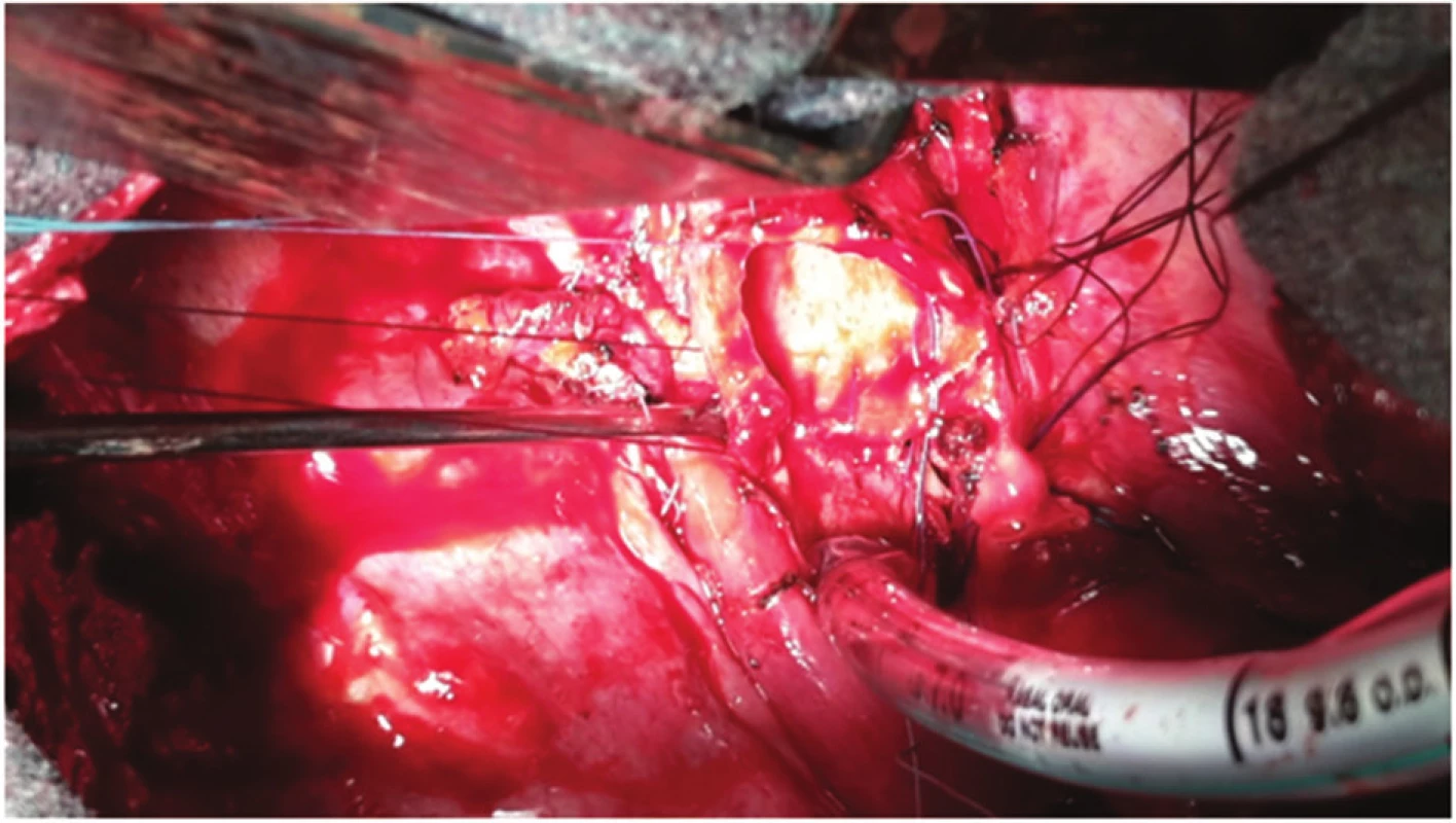 Selektivní intubace z operačního pole, stav po resekci kariny
Fig. 4: Selective intubation from the operation field; status after resection of carina