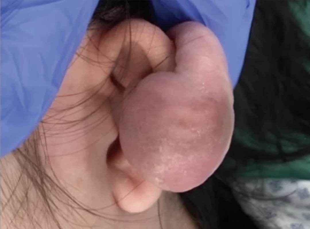  Keloid of the left earlobe.