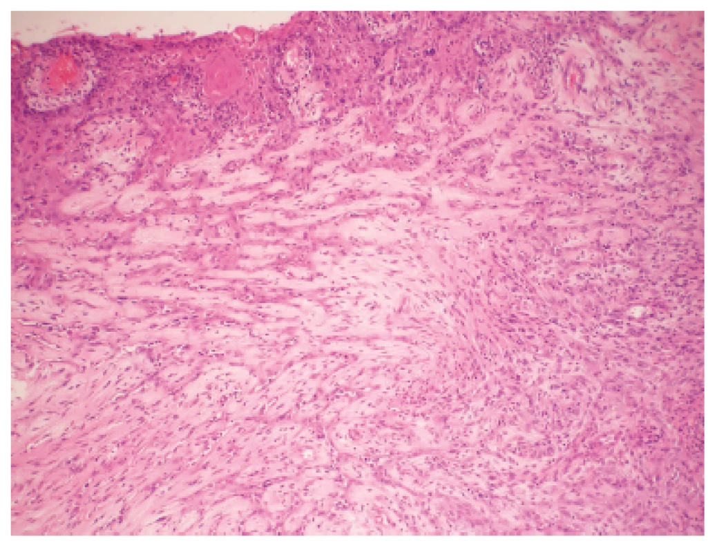 Časť steny cystickej dutiny s neoplasticky transformovaným dlaždicovým epitelom zabiehajúcim v podobe nepravidelných čapov do hlbšiích partií. H&amp;E, zvačšenie 100x.