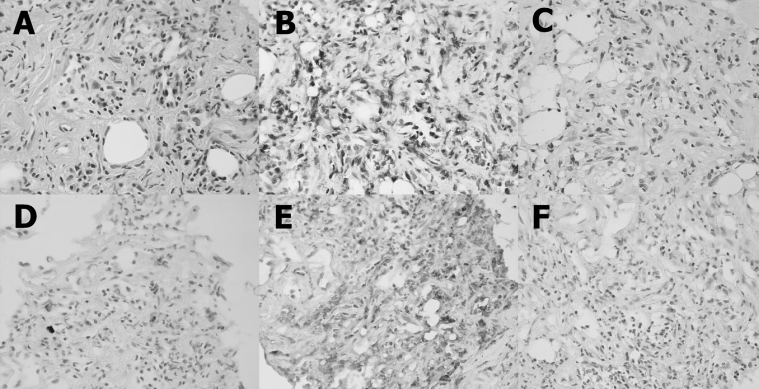 Histopatologický nález: Vzorek je tvořen buněčnou fibrotizovanou tkání s bohatým zastoupením buněčných elementů se zbytky tukové tkáně se smíšeným zánětlivým infiltrátem  (A). Dominujícím buňkami jsou T-lymfocyty (B). B-lymfocyty jsou zastoupeny v malém počtu  (C). Poněkud početněji jsou zastoupeny plazmatické buňky (D). Většina infiltrujících buněk, fibroblasty a makrofágy exprimují na svém povrhu CD68 (E). Estrogenního receptory alfa nejsou přítomny (F).