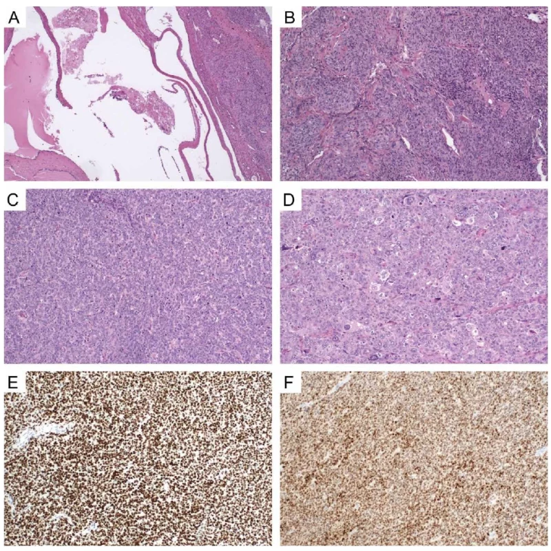 The representative morphological and immunohistochemical features of the tumors. A: Overview of the primary tumor (right) in close proximity to the structures of a mature cystic teratoma (left), 40x magnification (H&E staining). B: Histomorphology of the primary tumor, 100x magnification (H&E staining). C: Histomorphology of the recurrent tumor, 100x magnification (H&E staining). D: Histomorphology of the recurrent tumor (monstrous nuclei), 100x magnification (H&E staining). E: Aberrant p53 immunohistochemistry in the recurrent tumor, 100x magnification. F: Strong nuclear positivity of SF1 in the recurrent tumor, 100x magnification.