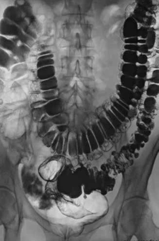 Dolichokolon – irigografie. Bizarní nález konfigurace kolon, vedlejším nálezem divertikulóza sigmatu. [Foto: Archiv autorů]