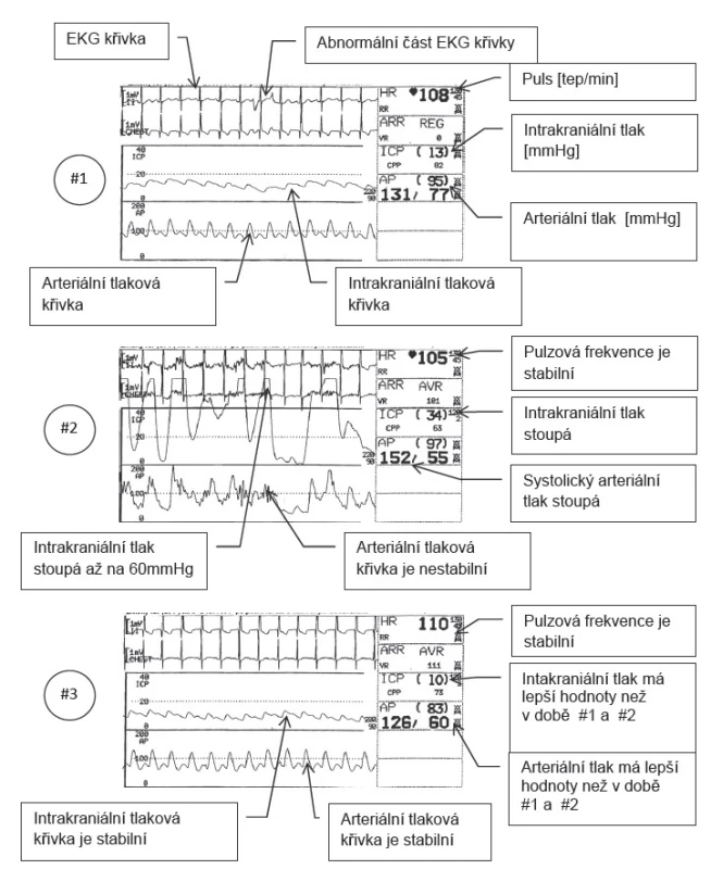Pulmonární laváž a následné odsávání
# 1 Hodnoty ICP, AP a HR před pulmonární laváží. Všechny hodnoty až na malou epizodu na EKG křivce jsou prakticky normální.
# 2 Hodnoty při plicním odsávání, zásadně roste intrakraniální a systolický tlak. Pulzová frekvence je stejně zvýšená jako před laváží.
#3 Hodnoty a křivky naměřené pět minut po laváži a odsávání. AP je normalizované, HR je stabilní a hodnoty ICP jsou lepší než před laváží.