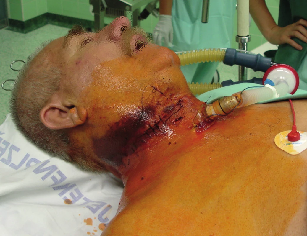 Nemocný připravován k akutní reoperaci
Fig. 2: The patient being prepared for urgent reoperation