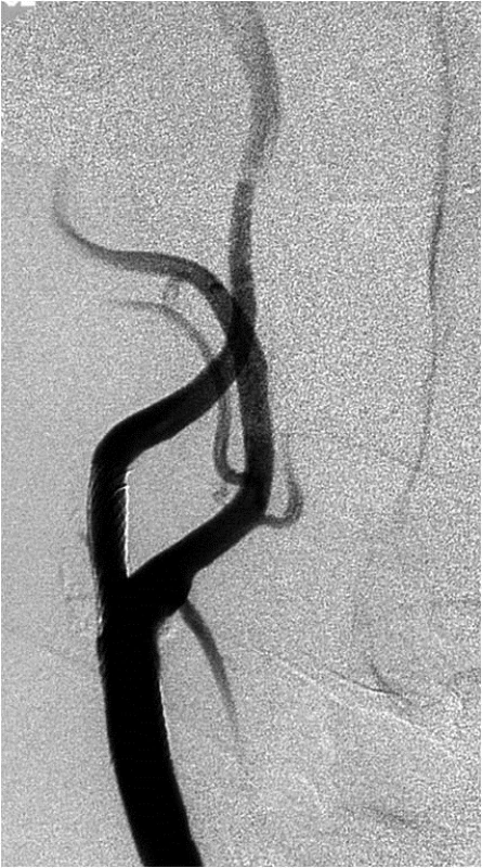 DSA pravé ACC – stav po implantaci stentu do pravé ACI