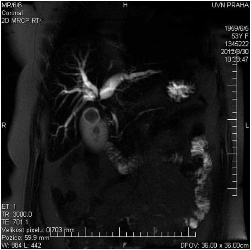 MRCP u nemocné s Klatskinovým tumorem Bismuth IIIA
Fig. 1: MRCP of patient with Klatskin tumor type Bismuth IIIA