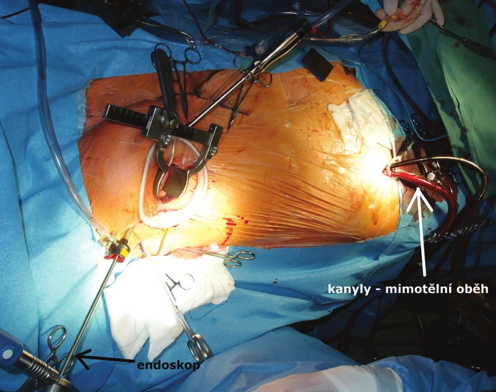 Pohled na operační pole – pravostranná minitorakotomie 
Kanyly mimotělního oběhu zavedené cestou femorálních cév (pravé tříslo).
Fig. 1: View on the operating field – right minithoracotomy 
Arterial and venous cannula of the extracorporeal circulation inserted in the femoral vessels (right groin).