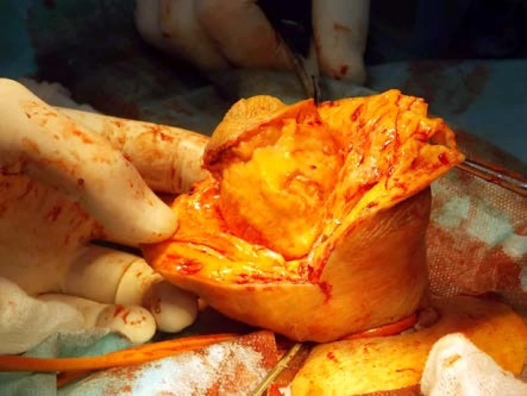 Peroperační excize změněné tkáně
Fig. 4. Intraoperative excision of the altered tissue
