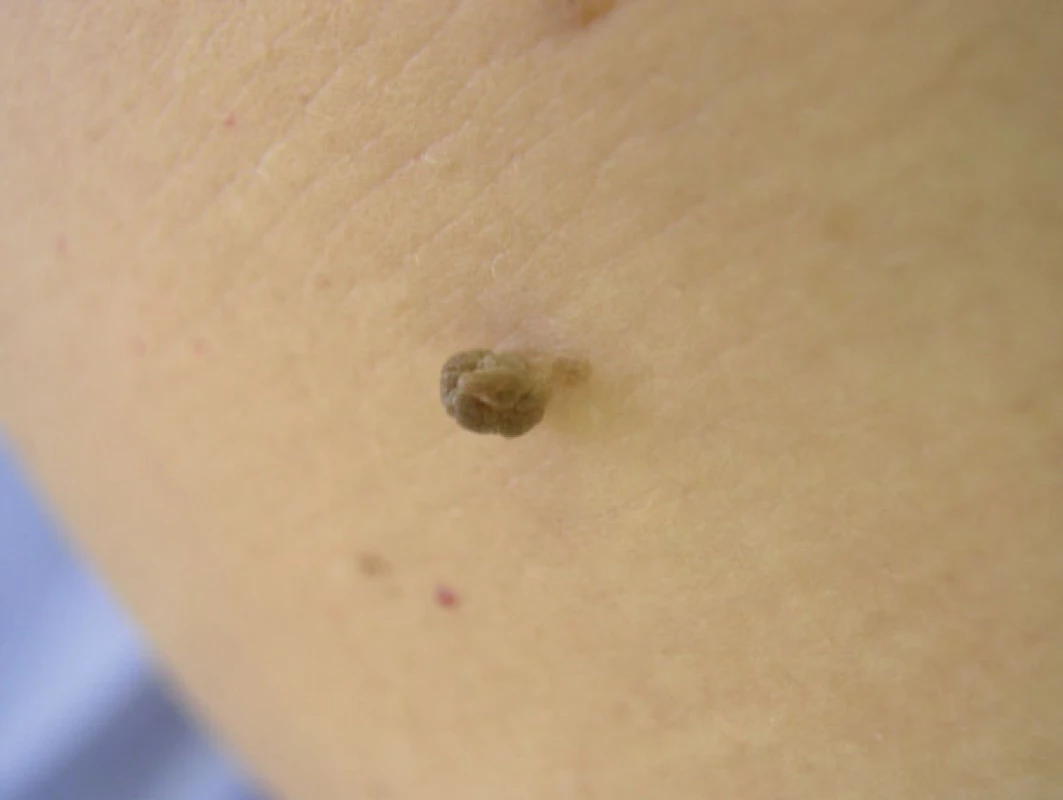 Klinický obraz pendulujúcich lézií