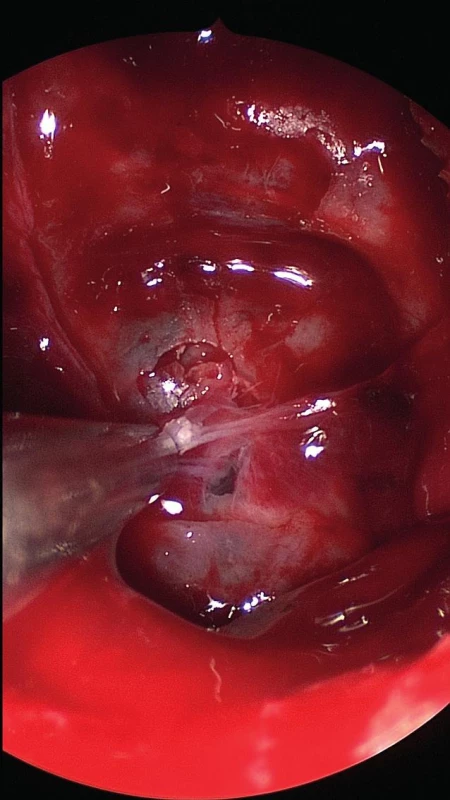 Peroperační nález: fraktura klivu a místo úniku mozkomíšního moku
Fig. 3: Intraoperative finding: fractured clivus and the site of cerebrospinal fluid leak