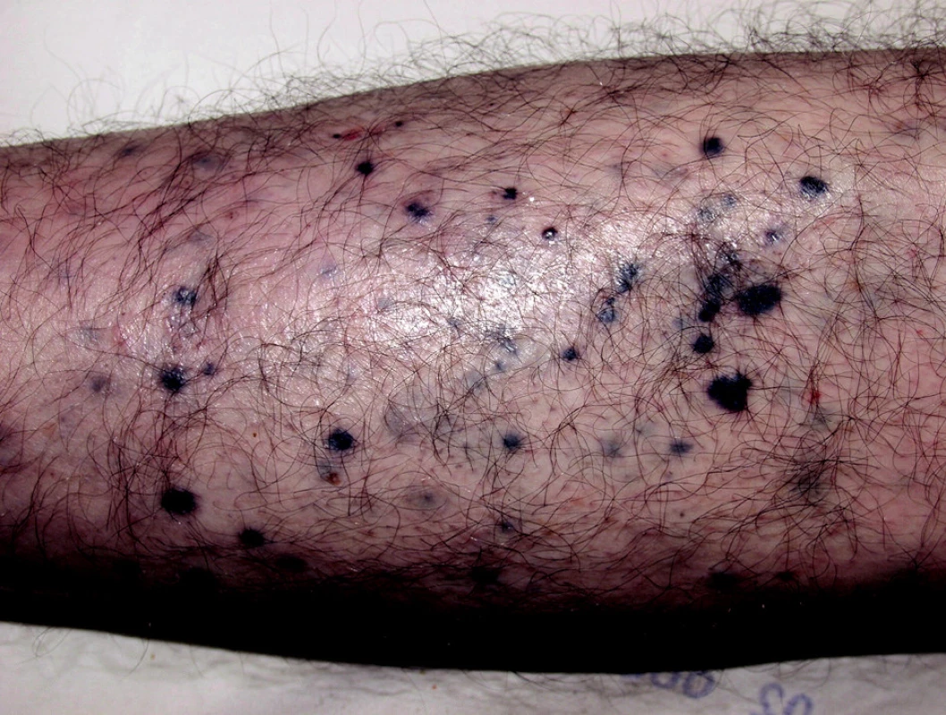 Metastázy melanomu.