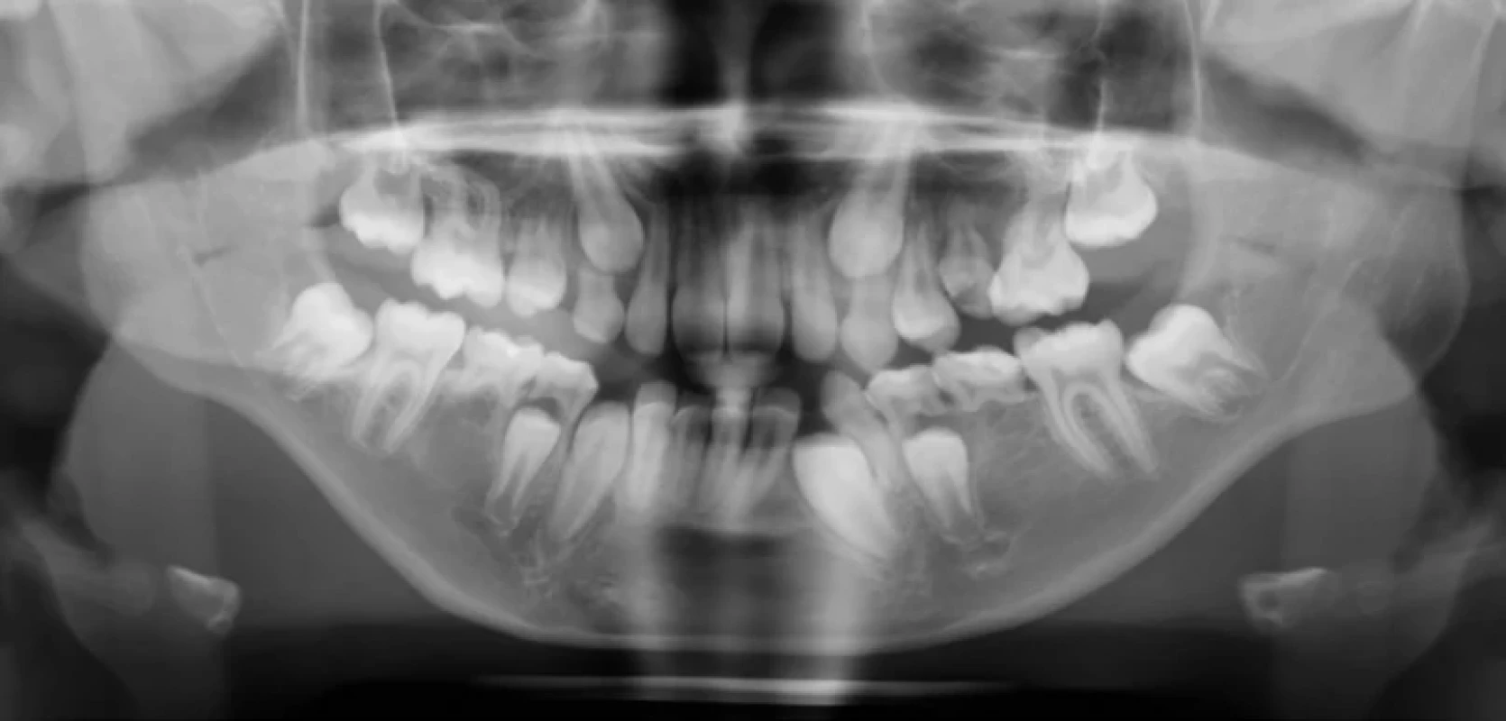 Ortopantomogram pacientky s Williamsovým-Beurenovým syndromem ve věku devíti let. Ageneze zubů 15, 35, 45 a třetích molárů; tvarová anomálie zubu 25 a 12, 11, 21, 22; asymetrická resorpce 73; porucha erupční dráhy zubů 33, 37, 47; zuby 75 a 85 před spontánní eliminací Fig. 2 Orthopantomogram of a 9-yearold female patient with Williams- Beuren syndrome. Agenesis of teeth 15, 35, 45, and third molars; morphological anomalies of teeth 25 and 12, 11, 21, 22; asymmetric resorption of tooth 73; eruption pathway disturbances of teeth 33, 37, 47; teeth 75 and 85 prior to spontaneous exfoliation.