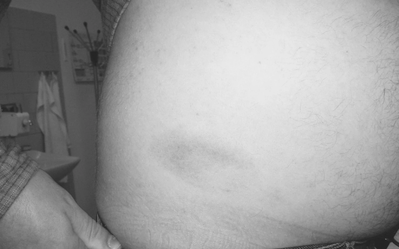 34letý muž s typickým E. m. vpravo na břiše. Udává kousnutí klíštětem před 2 měsíci. Po 2 baleních Deoxymykoinu se již nedostavil na kontrolu. Výskyt v 11. měsíci
