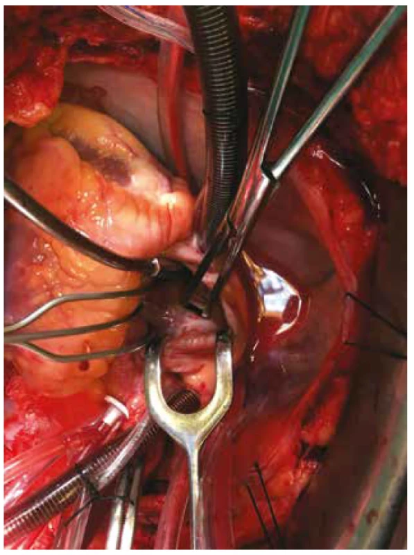 Foramen ovale patens<br>
Fig. 4: Patent foramen ovale