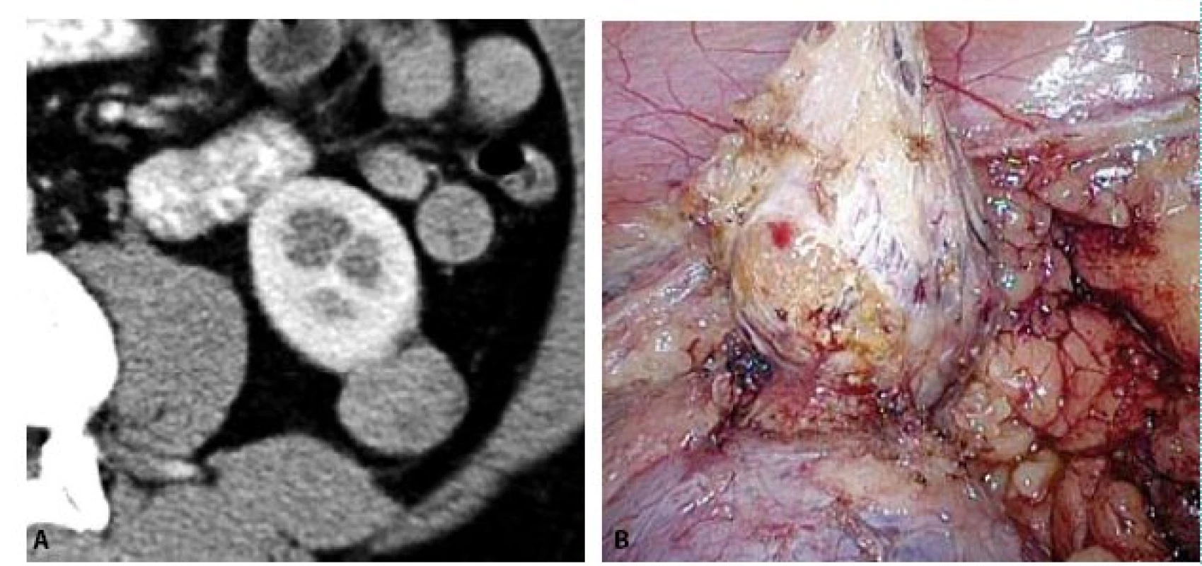 A, B. CT a fotografie z laparoskopie ukazují extrarenálně rostoucí papilární renální karcinom, který byl řešen bez kampování renálních cév
Fig. 5A, B. CT and peroperative photo show extrarenally growing papillary renal cell carcinoma, which was treated without camping of renal vessels