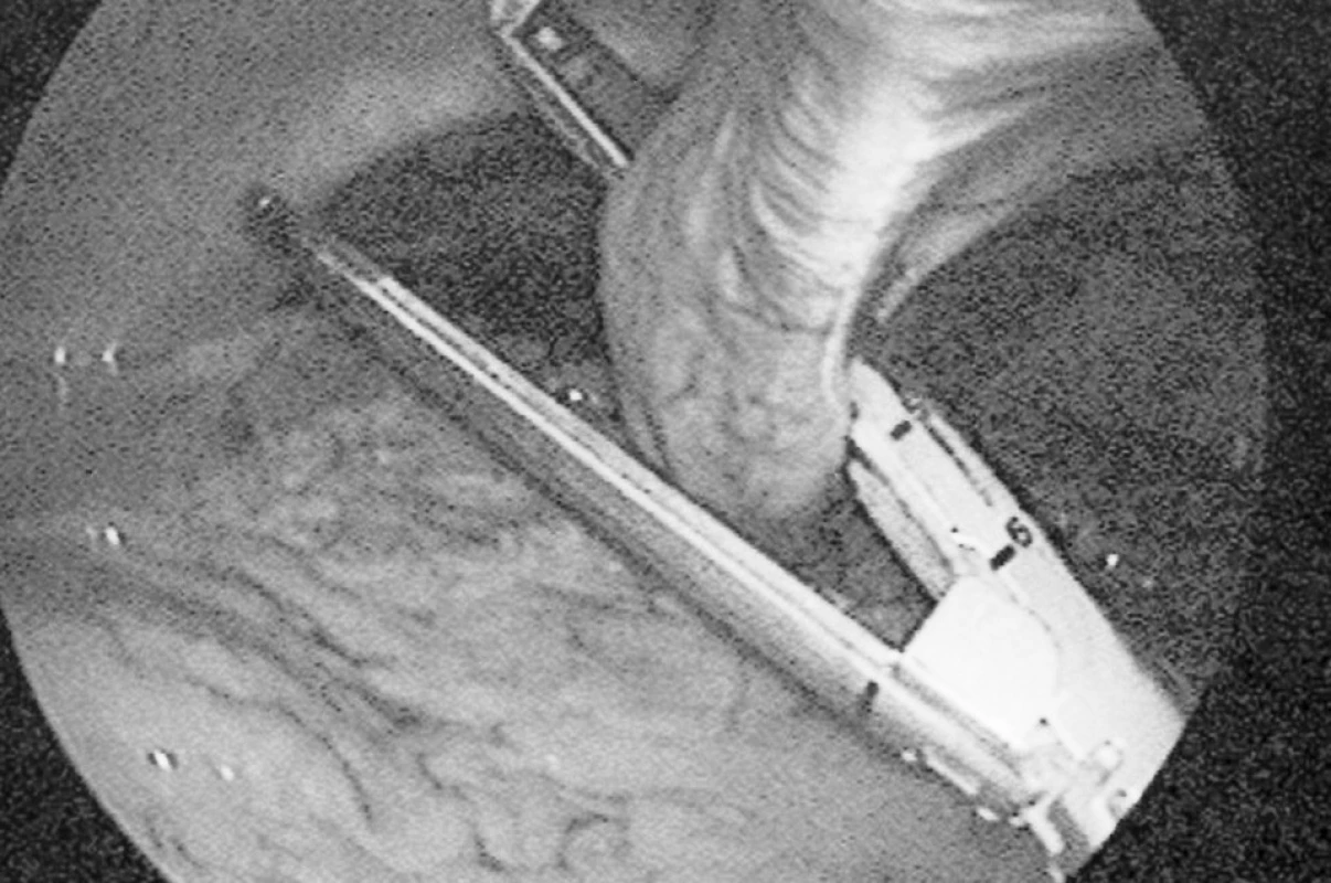 Naložení endoGia stapleru na dilatovanou umbilikální žílu
Fig. 3. Placing endoGia stapler at the dilatated umbilical vein