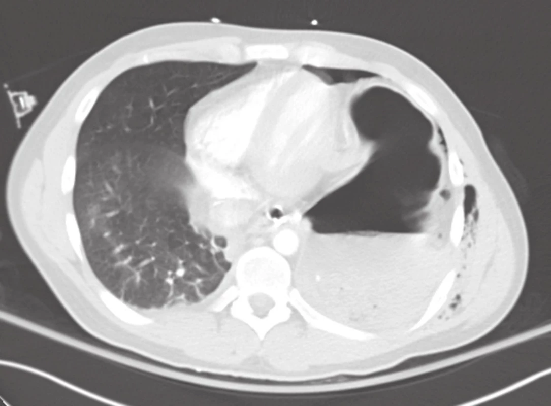 CT nález u levostranné ruptury bránice
Fig. 3: CT finding of left-sided diaphragmatic rupture
