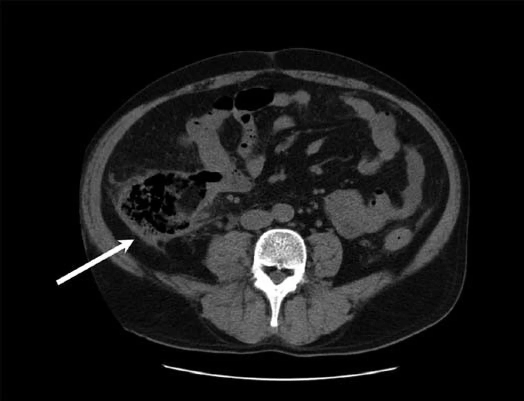 CT vyšetření břicha – nepravidelná dutina vyplněná nehomogenním obsahem s bublinkami plynu v retroperitoneu při zadní stěně colon ascendens (bílá šipka).
Fig. 2. Abdominal CT scan – irregular cavity filled with non-homogeneous content with gas bubbles in the retroperitoneum near the back wall of the colon ascendens (white arrow).