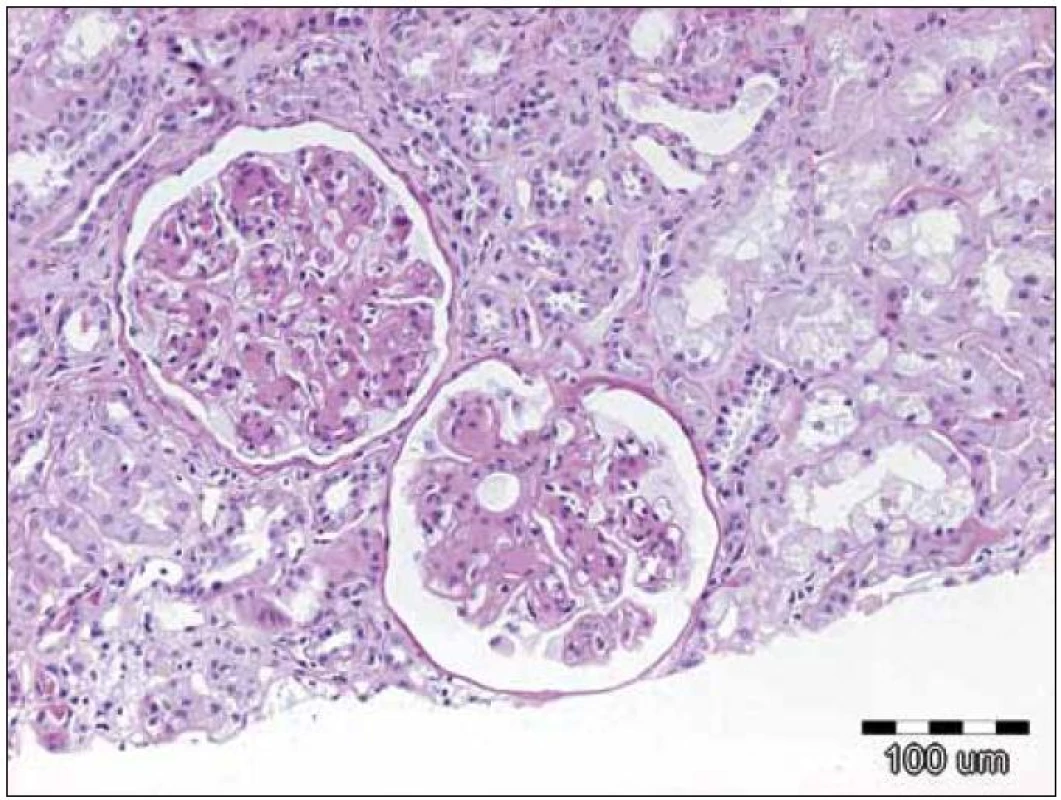 Zachycuje opticko‑mikroskopický obraz 2 glomerulů při depozici lehkých řetězců, kdy jsou přítomna depozita amorfního PAS pozitivního materiálu v mezangiu a ve stěně kapilár. Původní zvětšení 100krát, barvení PAS.