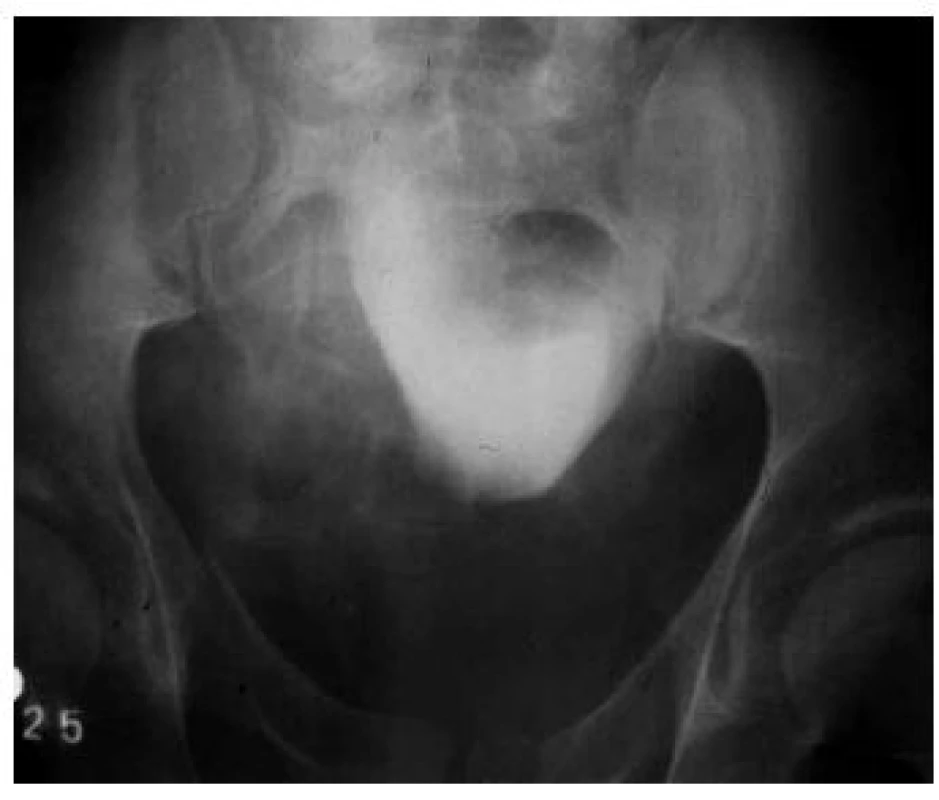 Cystografie při vylučovací urografii – kompletní ruptura zadní uretry s dislokací prostaty a močového měchýře kraniálně
Fig. 3. Cystography during excretory urography - complete rupture of the posterior urethra with cranial dislocation of the prostate and urinary bladder