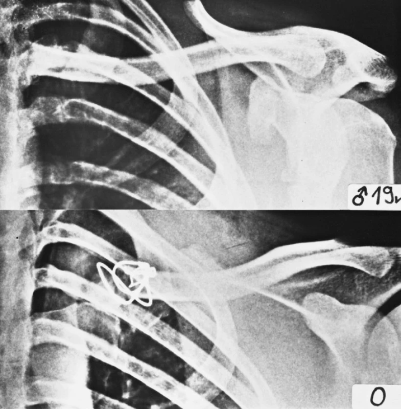 RTG snímek úrazový a snímek pooperační
Fig. 6. Preoperative and postoperative radiographs of extraarticular fracture of the medial end of the left clavicle