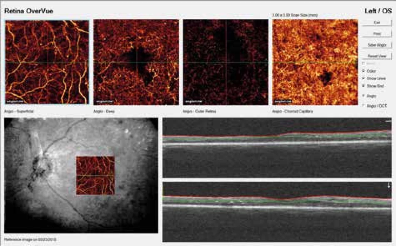NPDR s patologickým rozšírením fyziologickej avaskulárnej zóny, preriednutím kapilár, intraretinálnymi mikrovaskulárnymi abnormalitami, nikroaneuryzmami, nonperfúznymi zónami a zmenami v choriokapilaris v softwérom prifarbenom zobrazení