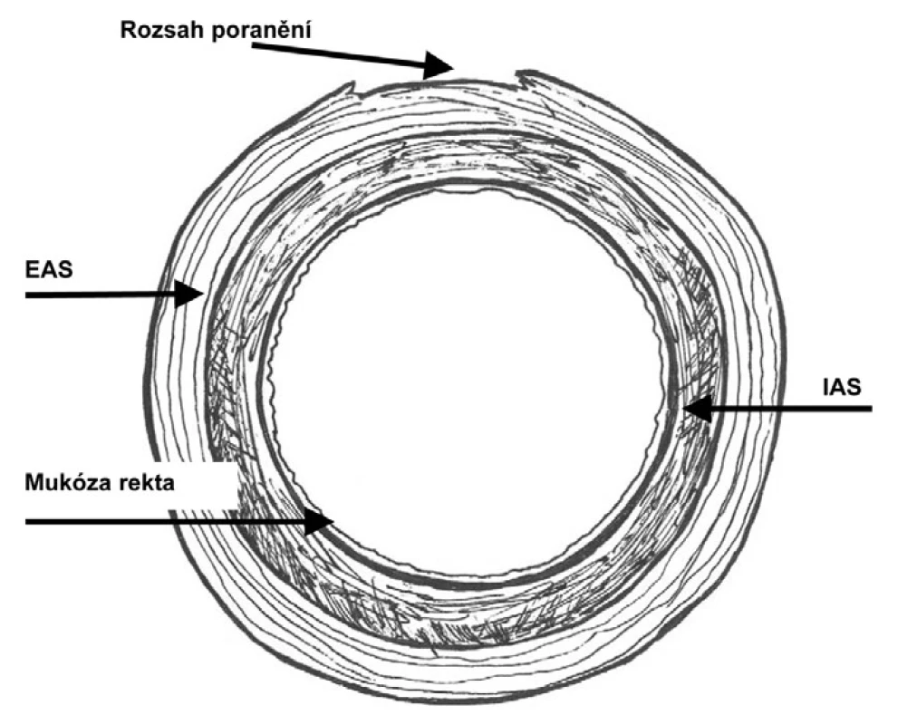 Ruptura perinea stupně 3a podle RCOG