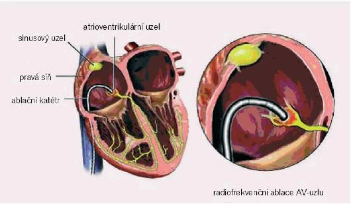 Pozice ablačního katétru při radiofrekvenční ablaci síňokomorové junkce.