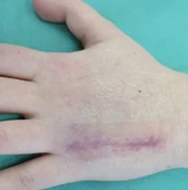 Final clinical result after device removal, showing healed scar and hand symmetry.
