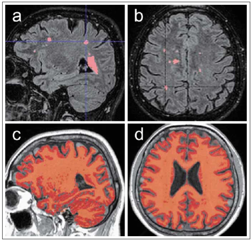 Ukázka automatizovaného měření objemu T2 hyperintenzních lézí a měření objemu celého mozku.
Fig. 4. Demonstration of automated volume measurement of T2 hyperintense lesions and volume measurement of the entire brain.