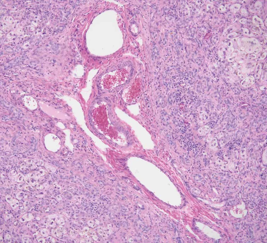 Alagilleův syndrom. Absence interlobulárního žlučovodu se zmnožením vaskulárních profilů v zánětlivě celulizovaném portálním poli. Barveno hematoxylinem eozinem (zvětšení 100x).