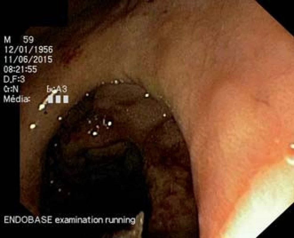 Gastroskopie – antegrádní gastroskopický pohled do pyloru a proximálního úseku duodena.  Tumorózní infiltrace s nekrotickými hmotami při postižení sliznice duodena a D2 difuzním velkobunečným  B lymfomem.
Fig. 1. Antegrade endoscopic view of the pylorus and proximal part of the duodenum. Tumour lesion with necrotic masses of diffuse B-cell lymphoma infiltrating in the proximal part of the duodenum.
