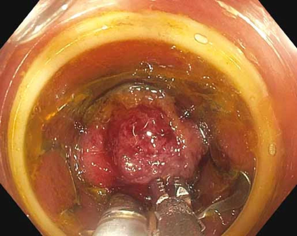 Zachycení centra léze kleštěmi, vtažení do „capu“ však není možné a kleště se postupně uvolňují.
Fig. 3. Capturing the centre of the lesion with tongs, dragging into the “cap” is not possible and tongs are gradually released.