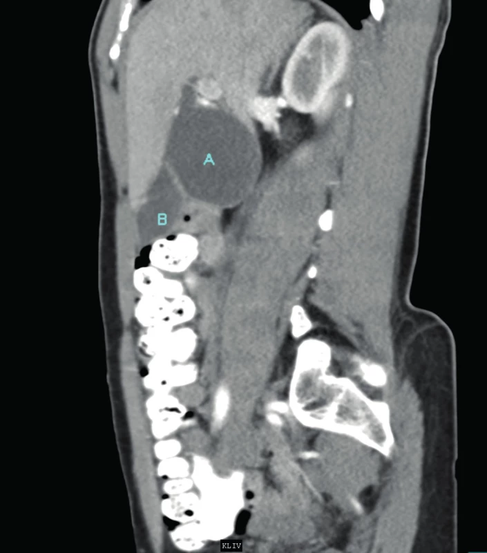 CT břicha v sagitální rovině (A – cysta ductus choledochus (v horní části ústí choledochu), B – žlučník)
Fig. 2: Sagittal abdominal CT image (A – choledochal cyst (ostium of the common bile duct in the upper part), B – gall bladder)
