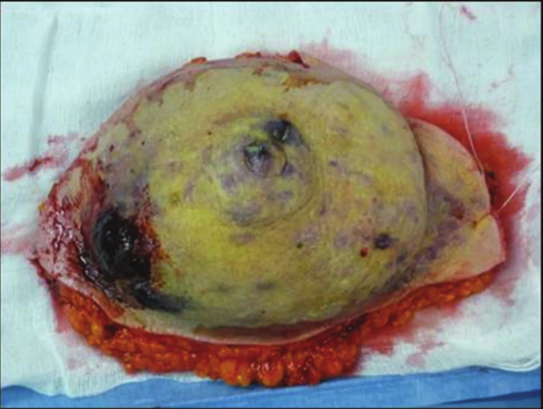 Snesený prs s mnohočetnými uzly angiosarkomu
Fig. 2: Multiple nodes of angiosarcoma in ablated breast